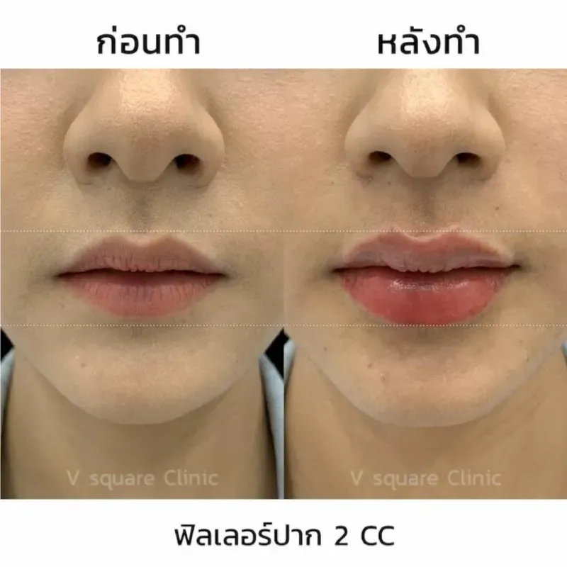ฉีดฟิลเลอร์ปาก รีวิว 2 CC