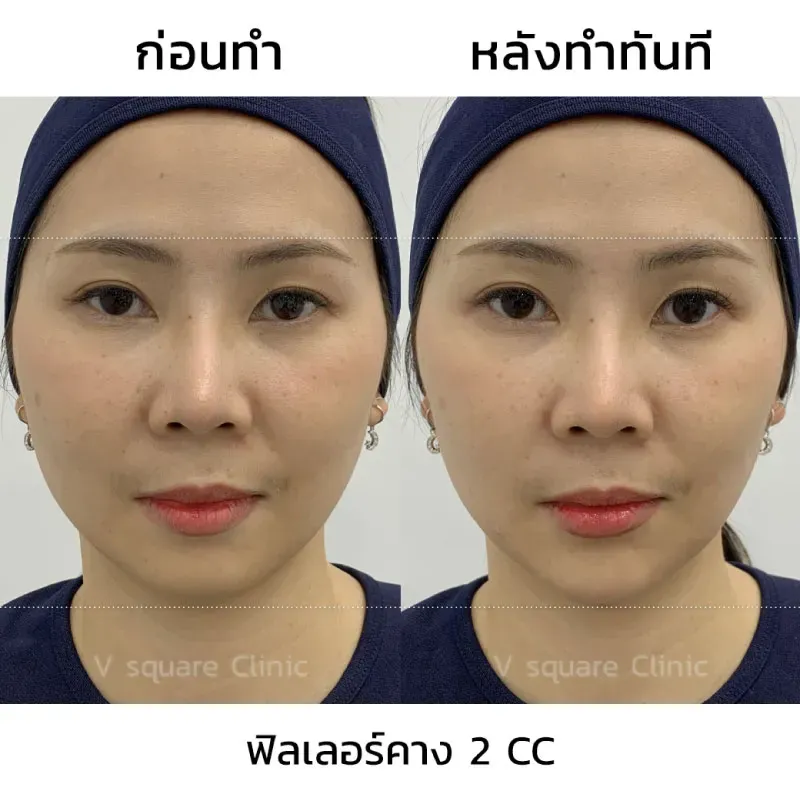 รีวิว Filler คาง 2 CC