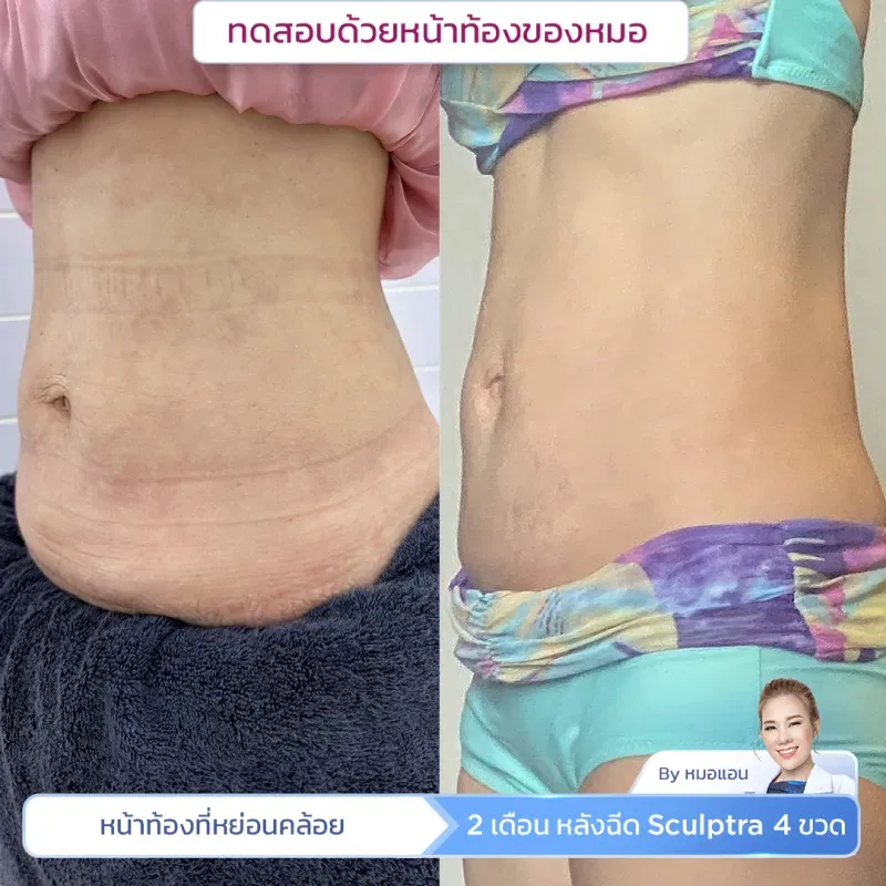 รีวิว Sculptra Body
