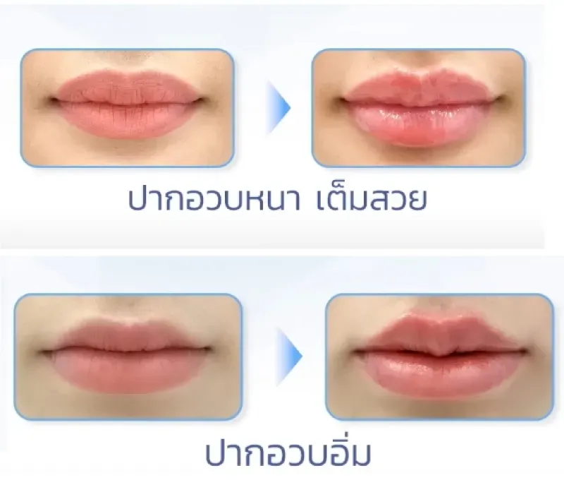 ฉีดฟิลเลอร์ปากราคา สายฝอ ฉีดฟิลเลอร์ปากราคา สายฝอ