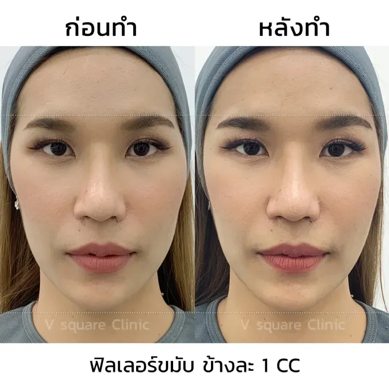 รีวิวฉีดฟิลเลอร์ขมับ