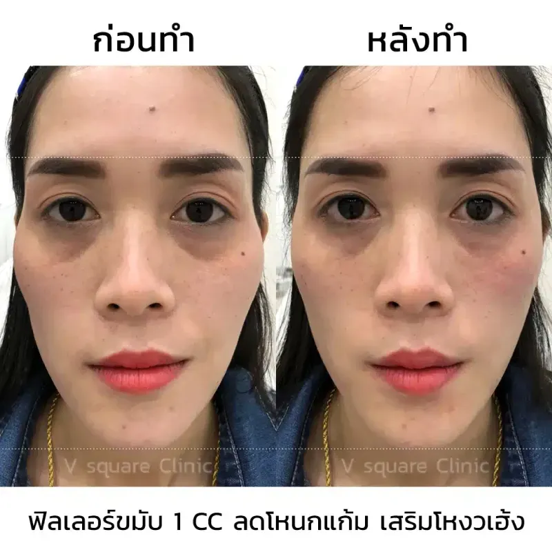 รีวิวฉีดฟิลเลอร์ขมับ