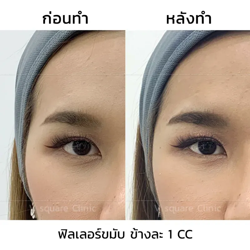 รีวิวฉีดฟิลเลอร์ขมับ