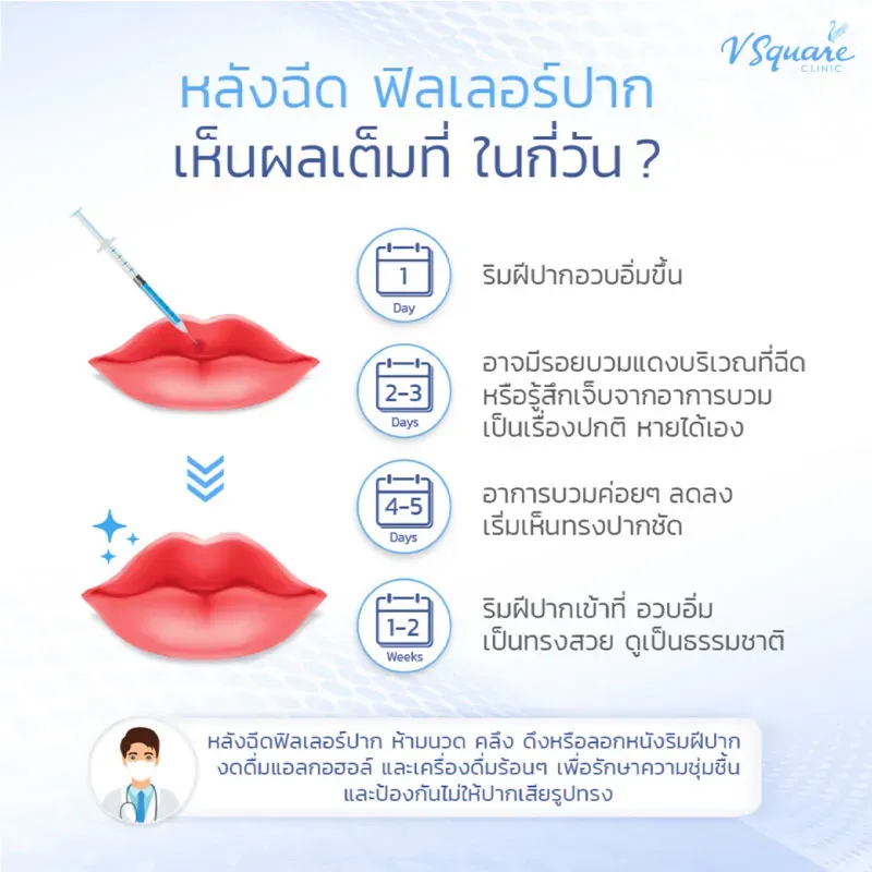 หลังฉีดฟิลเลอร์ปากกี่วันเข้าที่