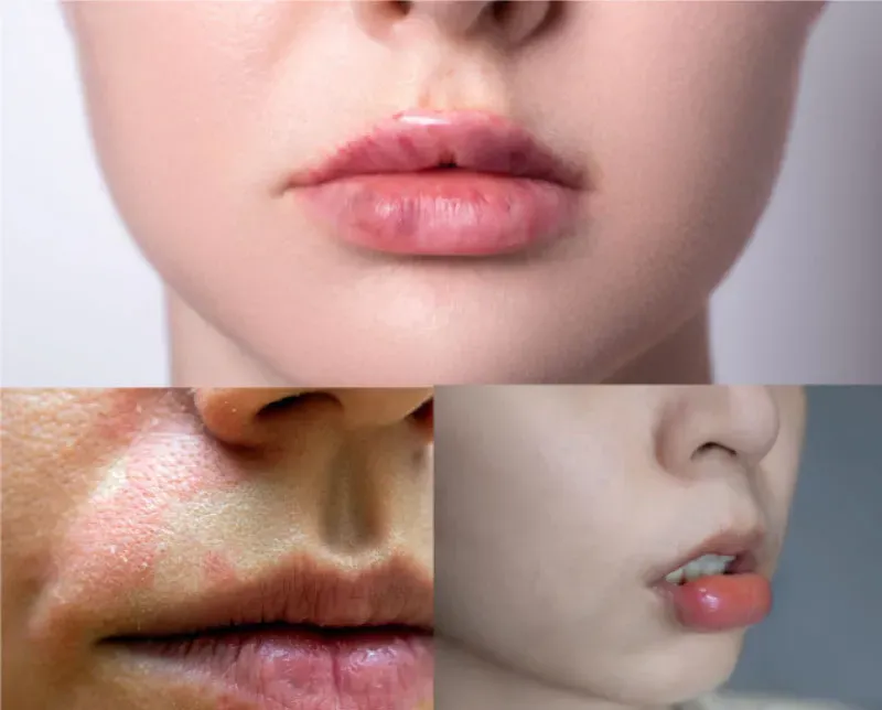 อาการผิดปกติหลังฉีดฟิลเลอร์ปาก