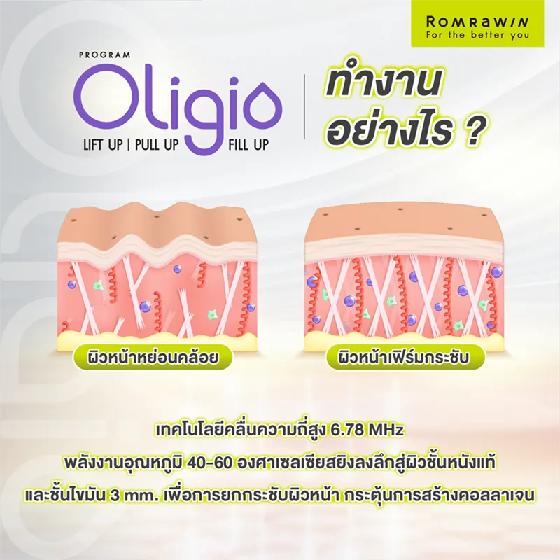 Oligio ยกกระชับใบหน้า