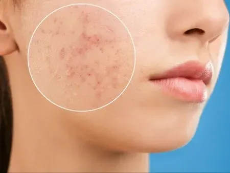 Meso รักษาสิว