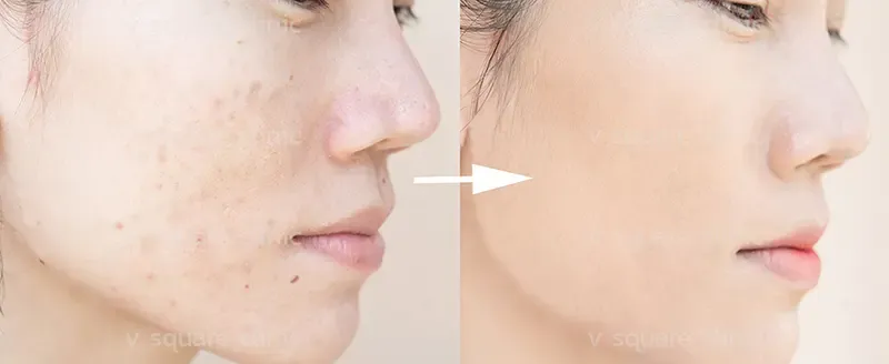 การฉีดเมโสรักษาสิว การฉีดเมโสรักษาสิว