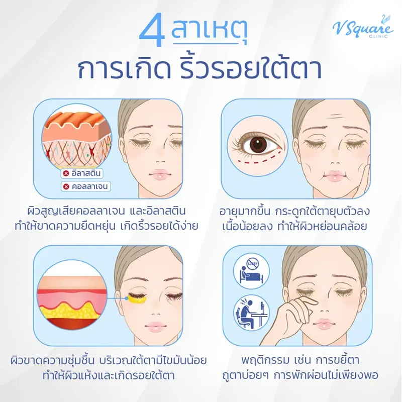 สาเหตุริ้วรอยใต้ตา