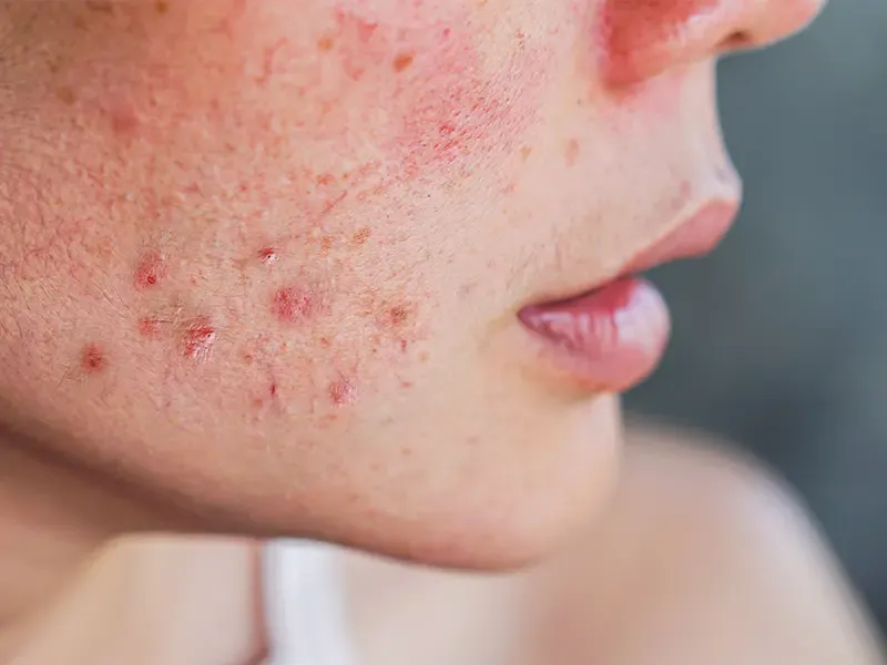 ฉีดเมโสหน้าใสราคาถูก เสี่ยงติดเชื้อ