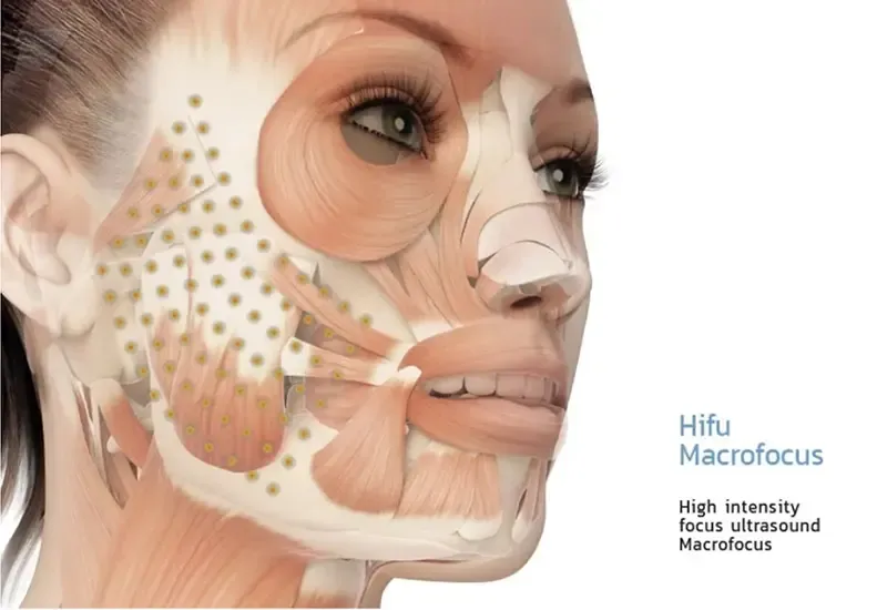 Hifu ขนาดพลังงาน Hifu ขนาดพลังงาน