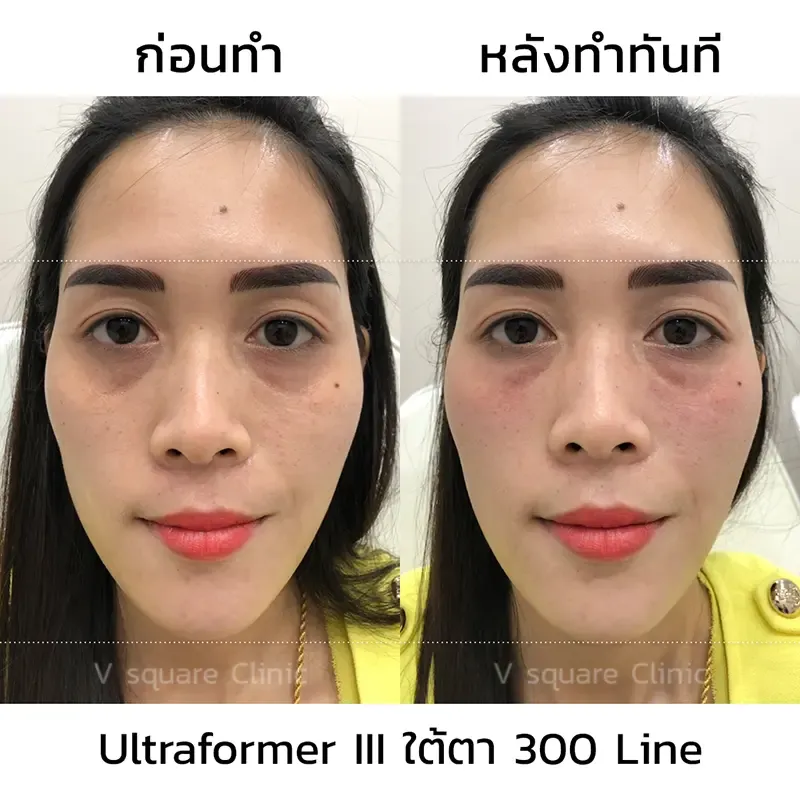 Hifu รีวิว Hifu รีวิว
