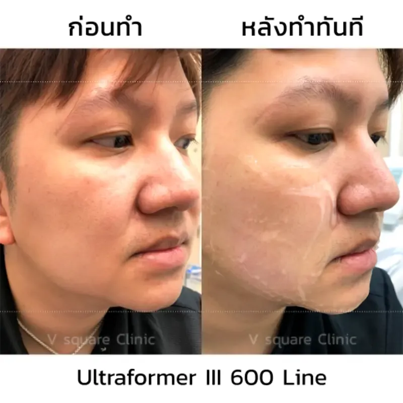Hifu รีวิว