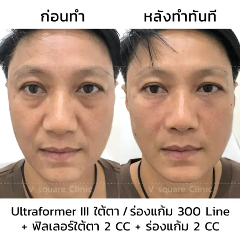 Hifu รีวิว