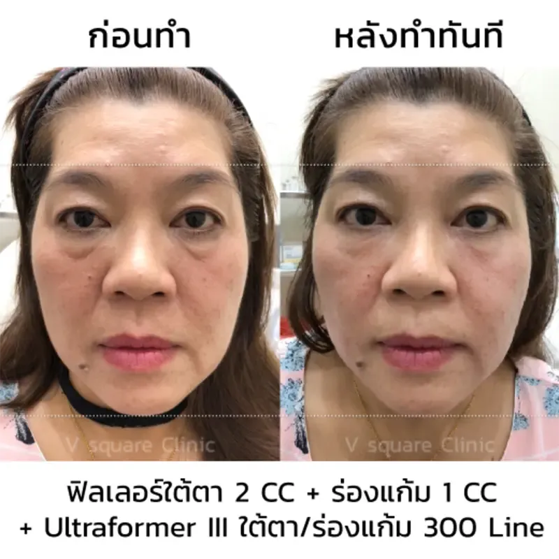 Hifu รีวิว