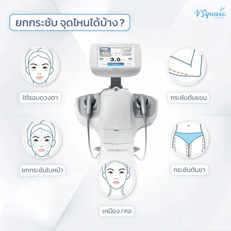 ทำ Ultraformer III จุดไหน ทำ Ultraformer III จุดไหน