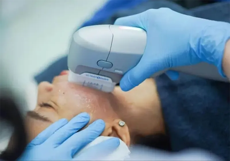 ผลลัพธ์หลังทำ Hifu