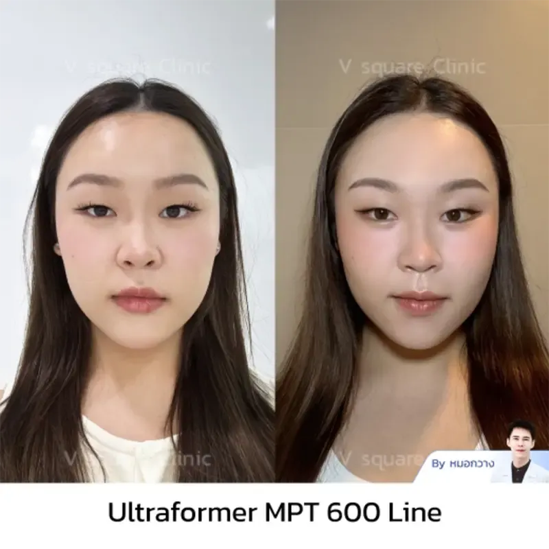 รีวิว Ultraformer MPT