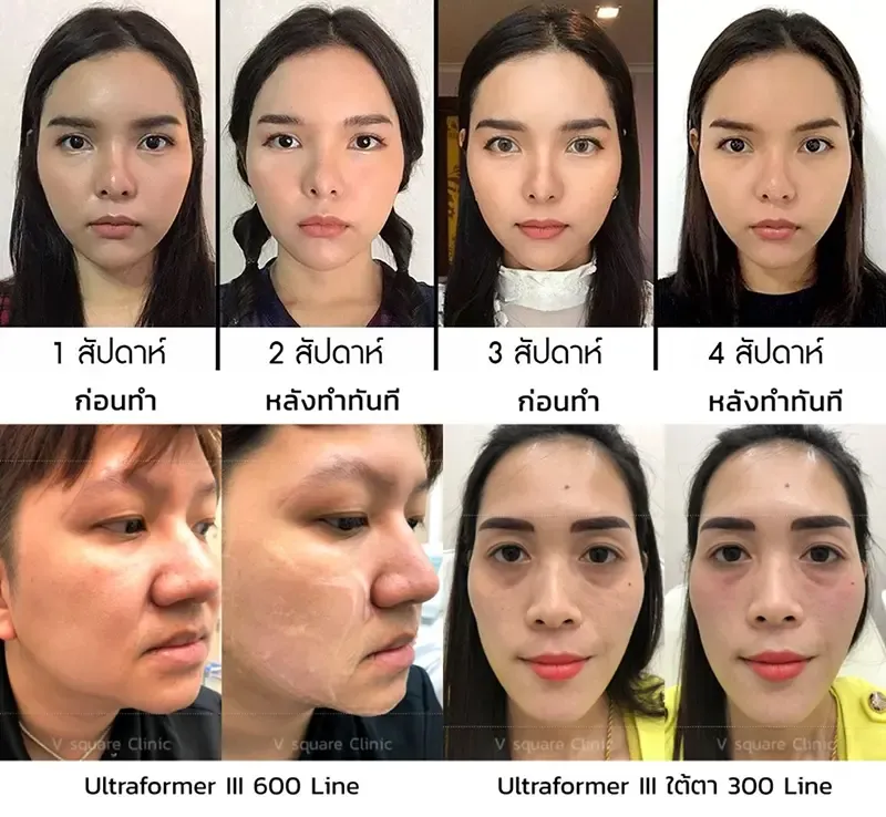 รีวิว หลังทำ Hifu 