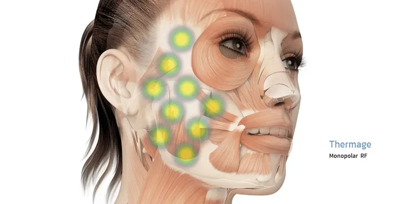 Thermage ขนาดพลังงาน Thermage ขนาดพลังงาน