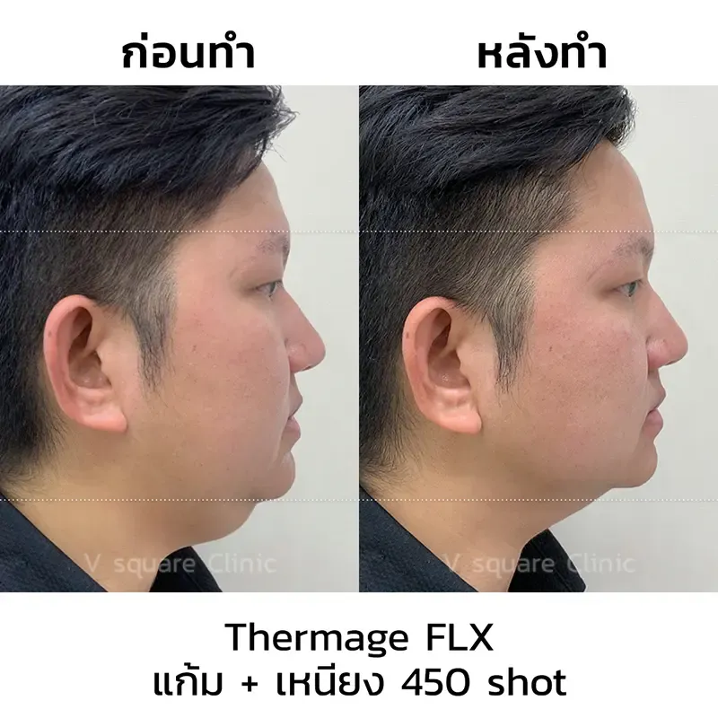 Thermage รีวิว Thermage รีวิว