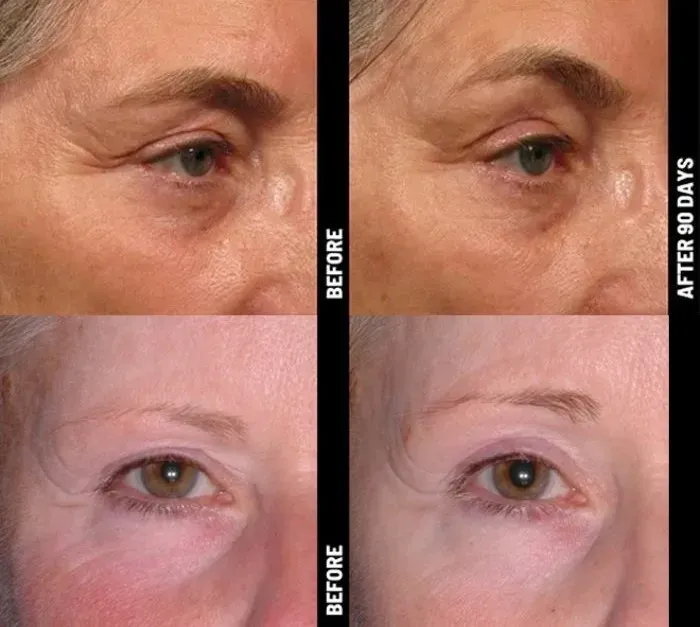 Ulthera รอบดวงตา รีวิว