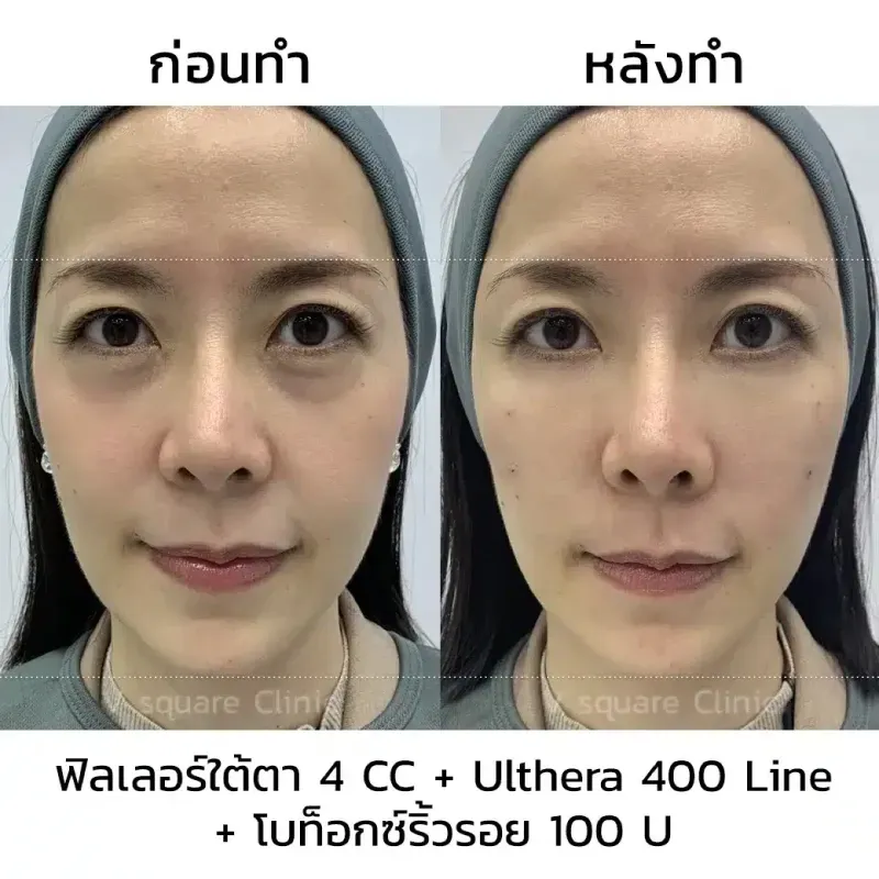 Ulthera รอบดวงตา รีวิว