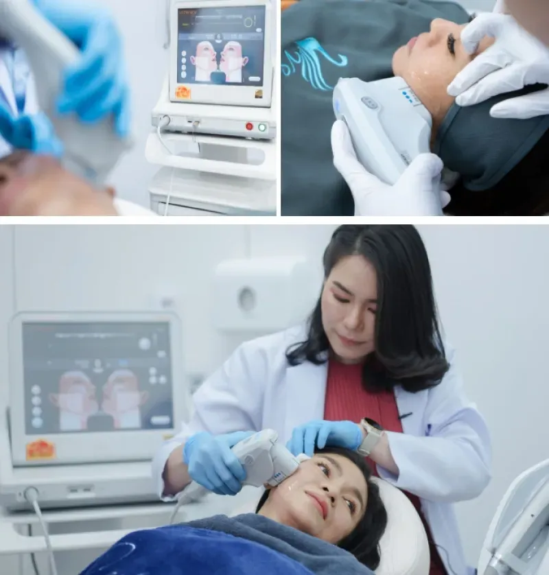 Ulthera ราคาแพง แต่อยู่ได้นานถึง 1 ปี