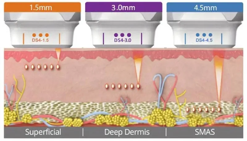 Ulthera ราคา ขึ้นอยู่กับไลน์การยิง