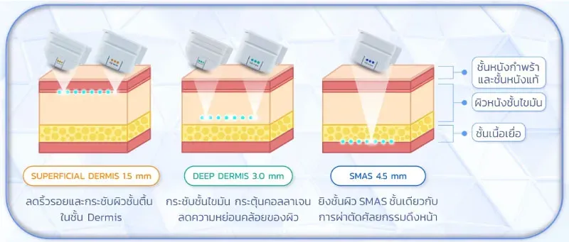 หัวยิง Ulthera Prime หัวยิง Ulthera Prime