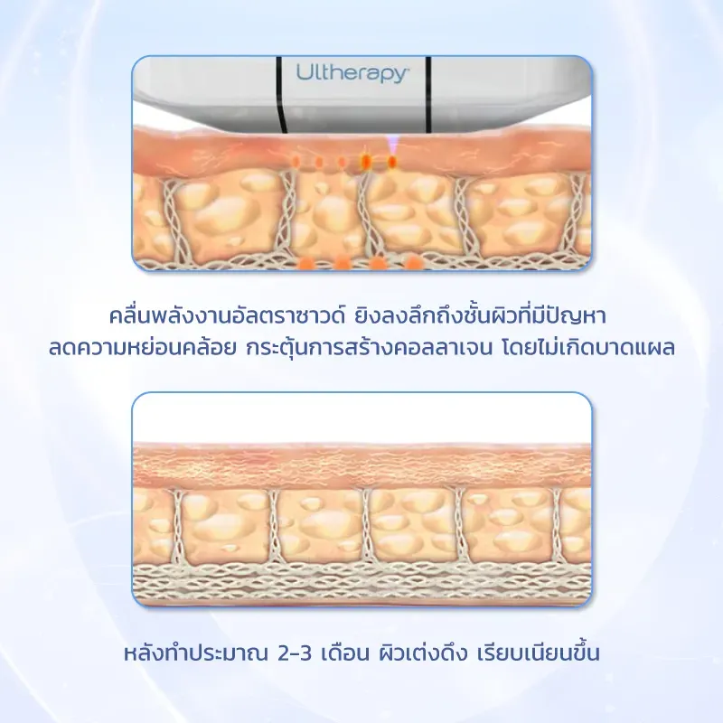 Ulthera หลักการทำงาน Ulthera หลักการทำงาน