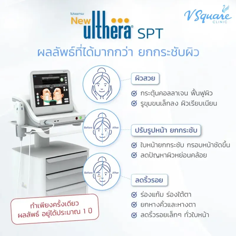 Ulthera SPT-ผิวสวย -หน้าเด็ก Ulthera SPT-ผิวสวย -หน้าเด็ก