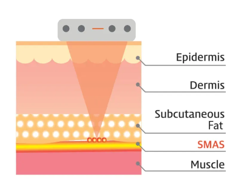 Ulthera SPT ยกผิวถึงชั้น SMAS Ulthera SPT ยกผิวถึงชั้น SMAS
