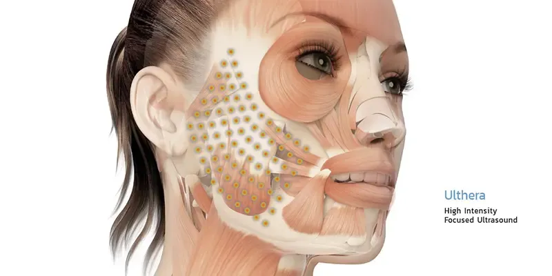 Ulthera ขนาดพลังงาน Ulthera ขนาดพลังงาน