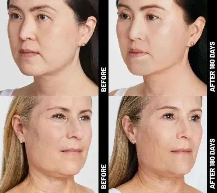 Ulthera รีวิว Ulthera รีวิว