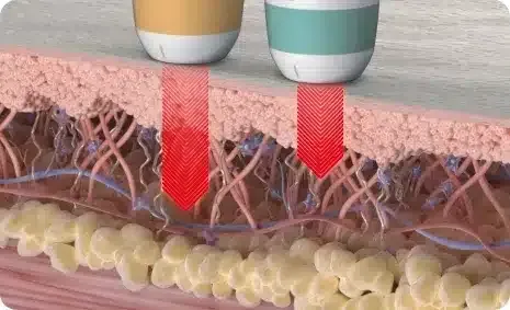 การทำงาน Ultraformer MPT