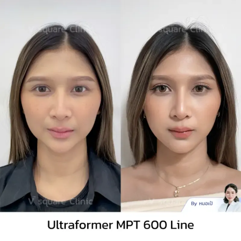 Ultraformer MPT รีวิว