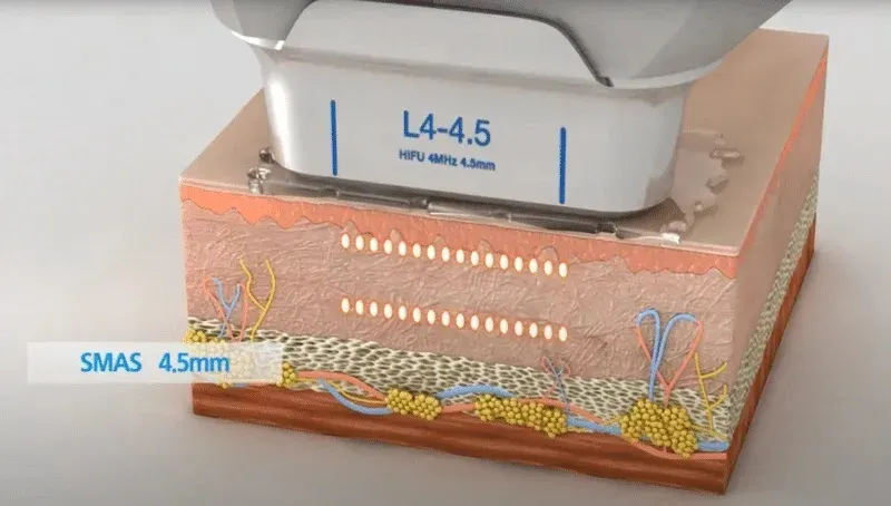 Ultraformer III หลักการทำงาน Ultraformer III หลักการทำงาน
