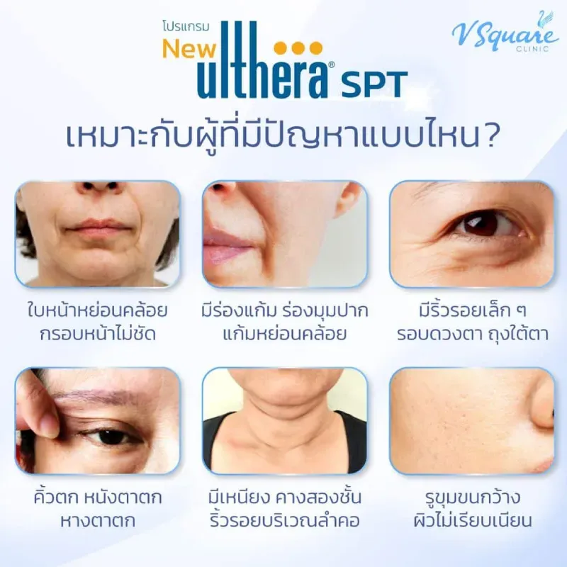 Ulthera SPT เหมาะกับใคร Ulthera SPT เหมาะกับใคร