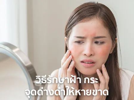 วิธีรักษาฝ้า กระ ให้ หายขาด แบบธรรมชาติ