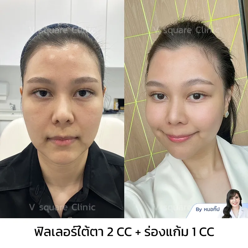 รีวิวแก้ร่องแก้มลึก_คุณจ๊ะโอ๋ อินฟลู รีวิวแก้ร่องแก้มลึก_คุณจ๊ะโอ๋ อินฟลู