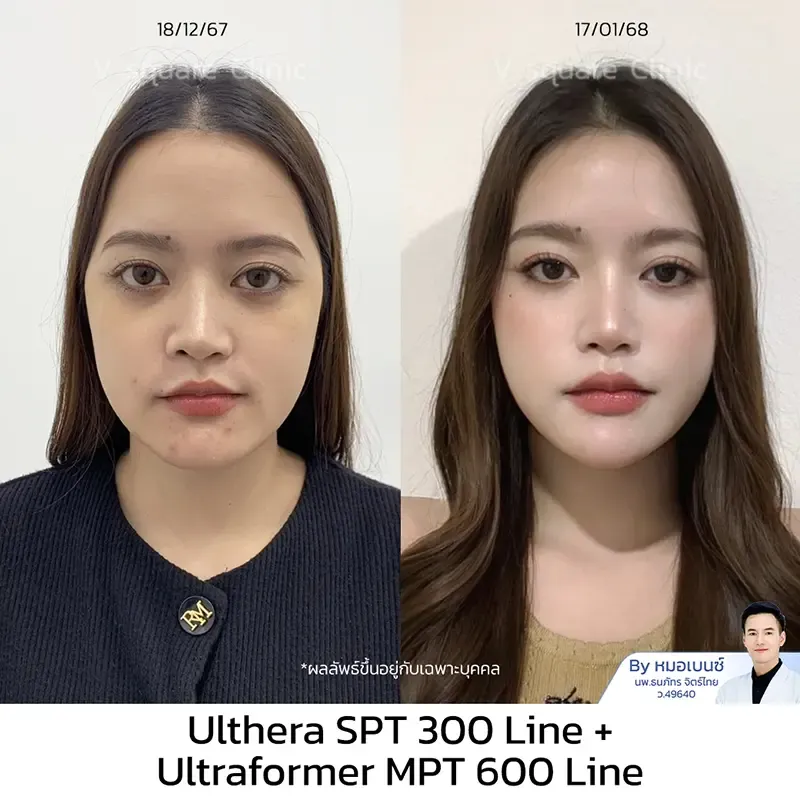 Ulthera SPT ทั่วหน้า_คุณเฟรนด์ UL SPT+MPT