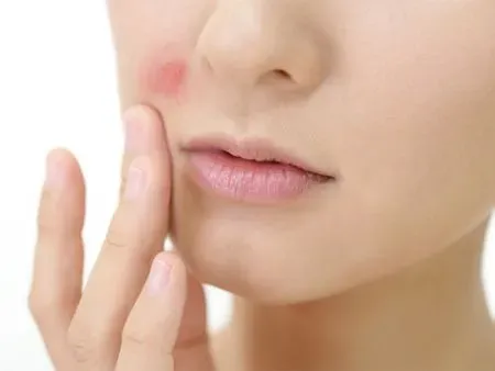 ฟิลเลอร์ปลอม - Filler หิ้ว อันตราย