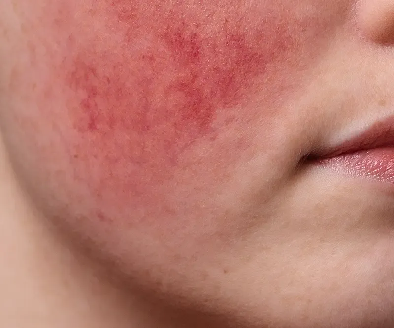 แพ้มาเด้คอลลาเจนปลอม แพ้มาเด้คอลลาเจนปลอม