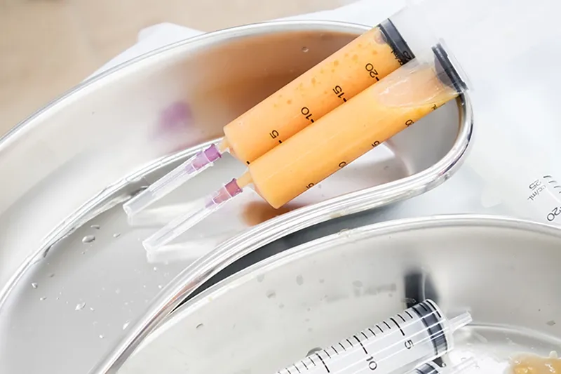 ฉีดไขมัน แก้ร่องแก้มลึก ฉีดไขมัน แก้ร่องแก้มลึก