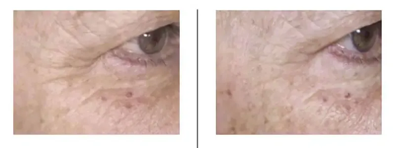 รีวิว Filorga ใต้ตา