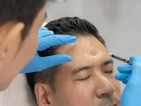 ฉีดฟิลเลอร์หน้าผาก