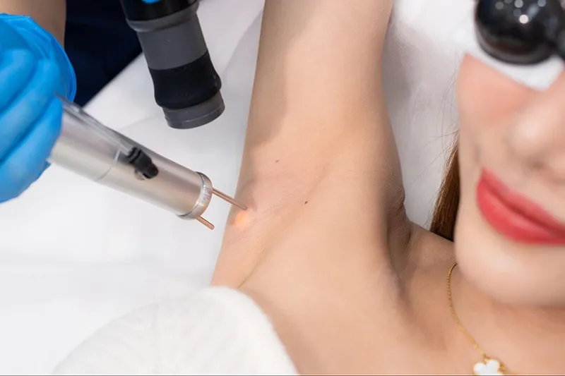 เลเซอร์กำจัดขน