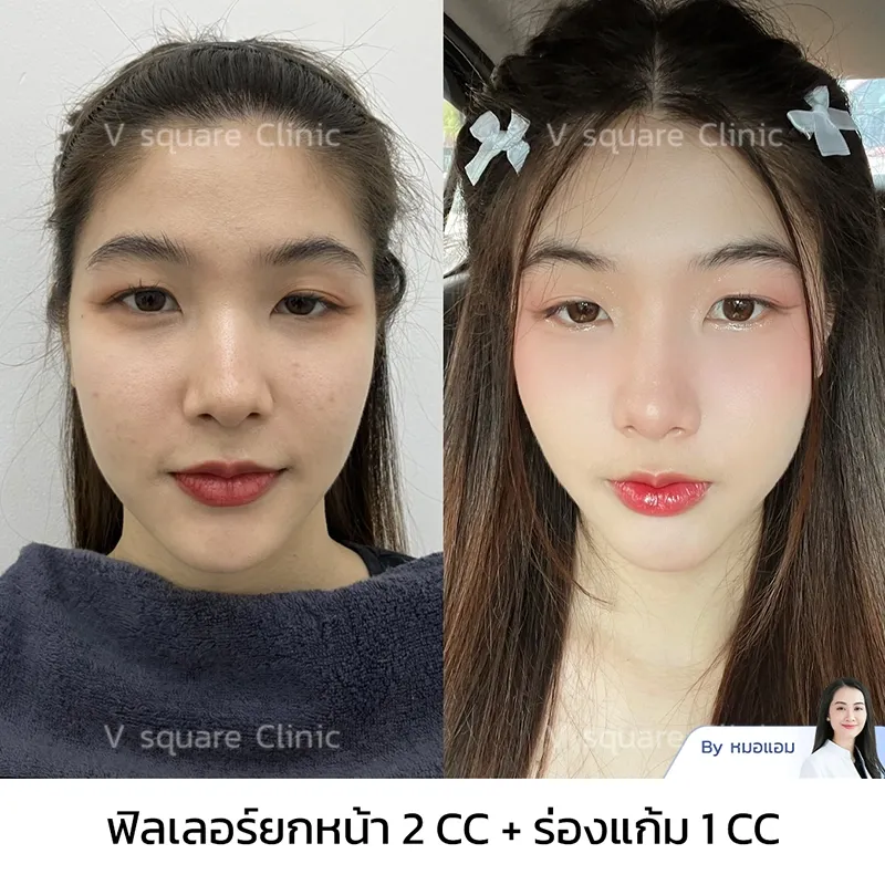รีวิวแก้ร่องแก้มลึก_คุณซี อินฟลู รีวิวแก้ร่องแก้มลึก_คุณซี อินฟลู