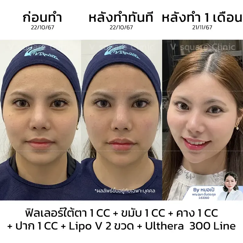 รีวิวอัลเทอร่า_น้องเตย (หน้าเรียว)